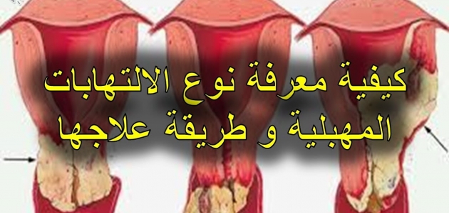 تعرف على أسباب وأعراض التهاب المهبل الجرثومي برايم نيوز