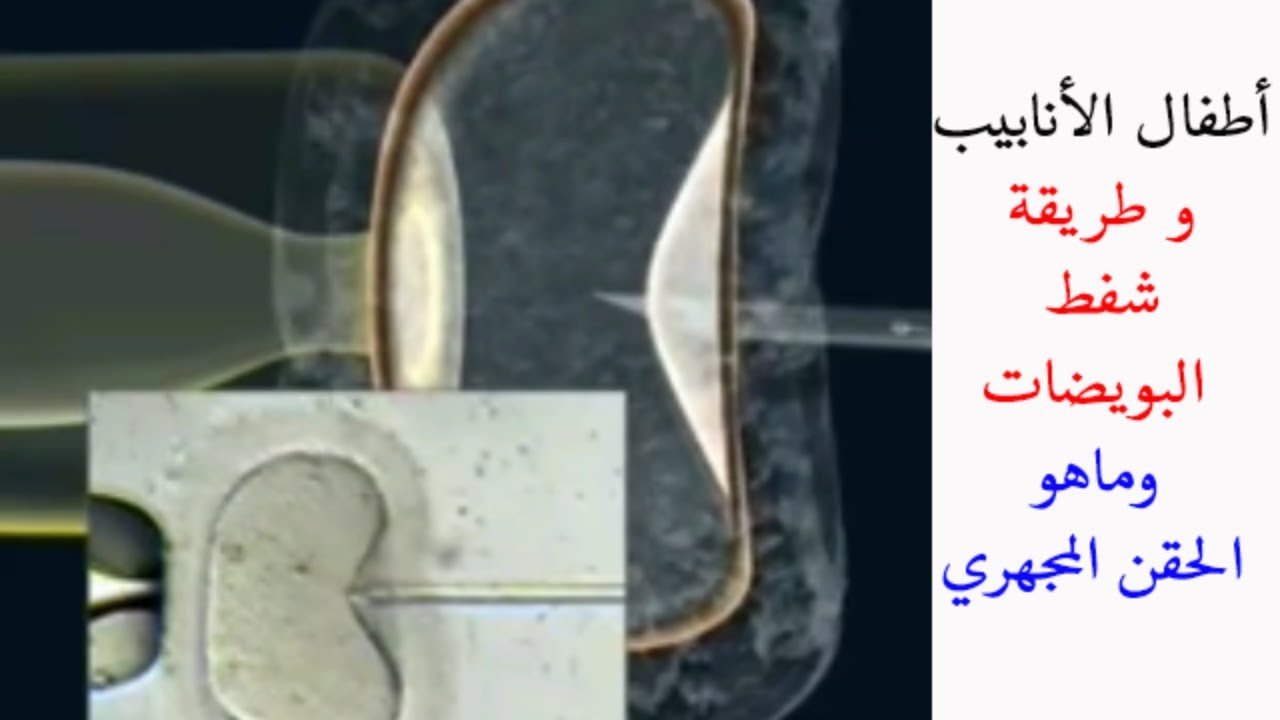 تعرف معنا على إجراءات و طريقة الحقن المجهري