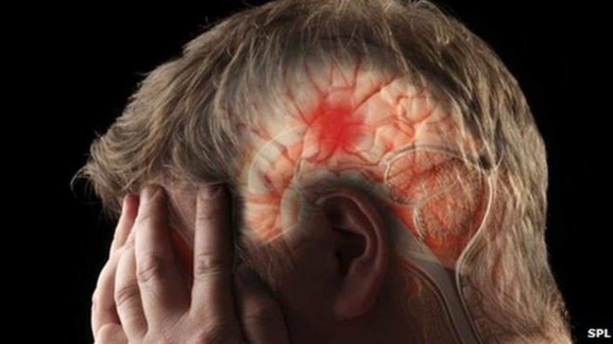 كيفية الوقاية من جلطة المخ وكيفية علاجها