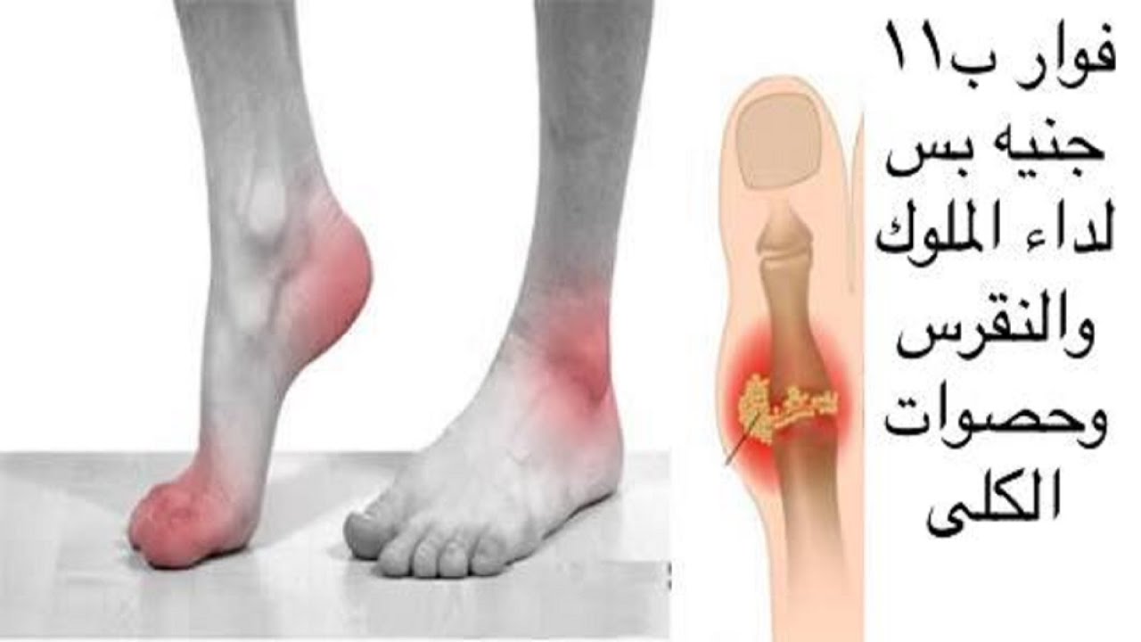 ماذا تعرف عن النقرس (داء الملوك)