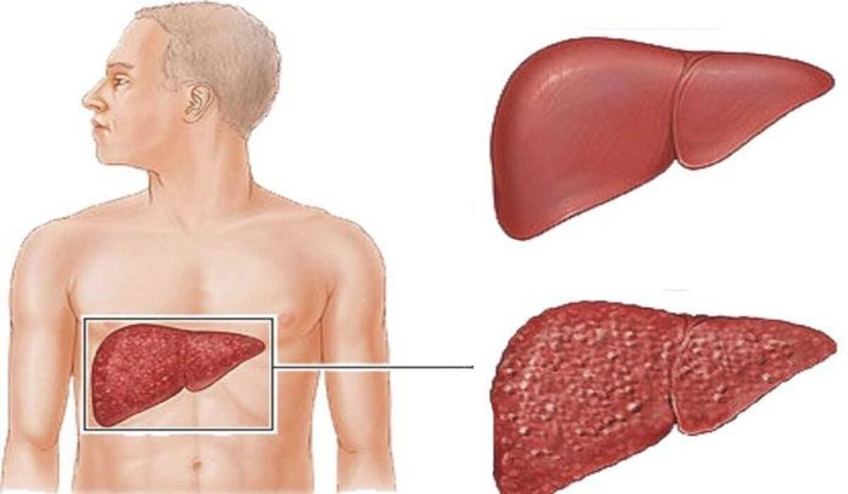 معلومات هامة تعرف عليها عن أعراض الكبد الوبائي كي تقي جسمك منها