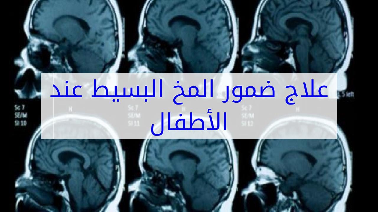 معلومات هامة عن إصابة الأطفال بضمور في المخ