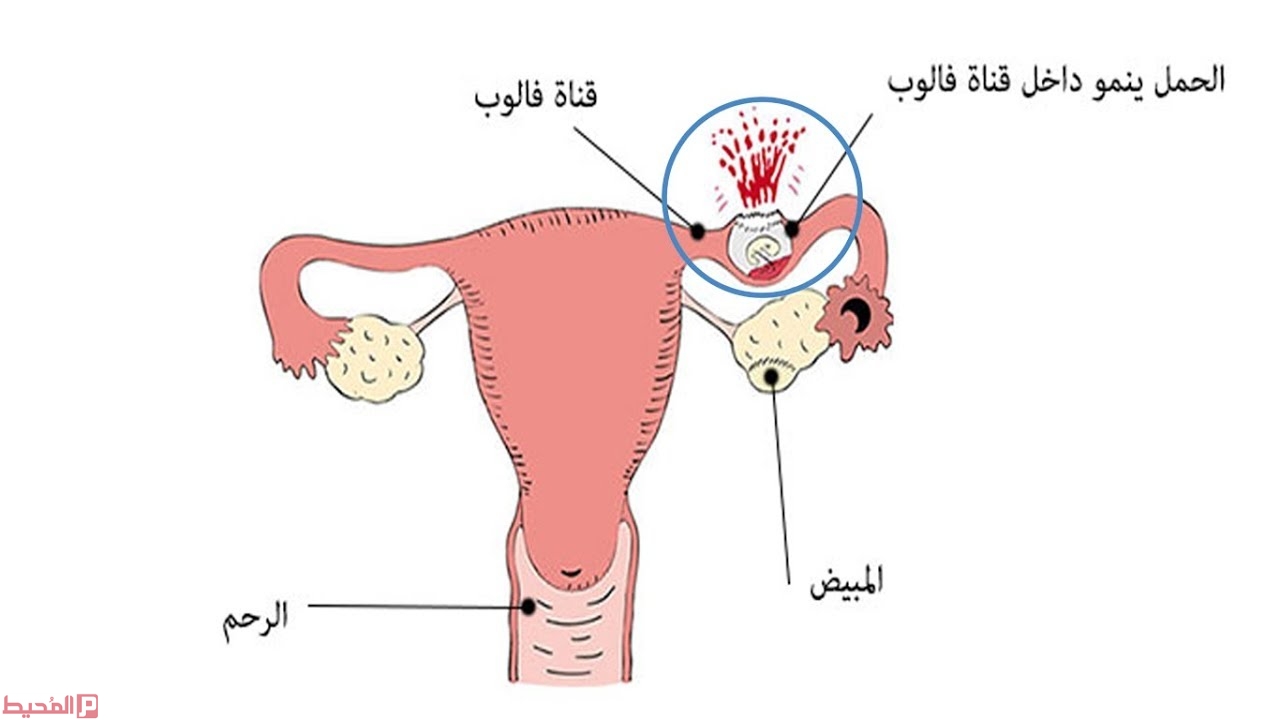 معلومات هامة عن الحمل المنتبذ وأعراضه