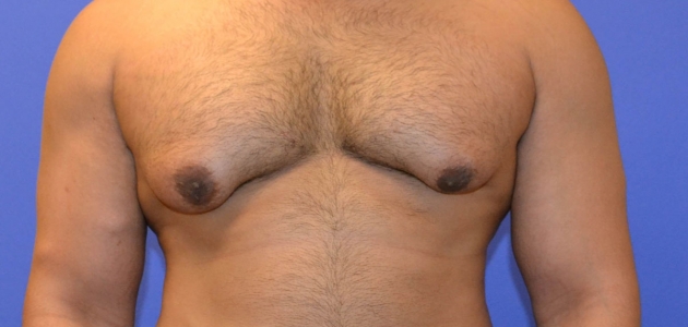 هل يمكن تشخيص وعلاج تضخم الثدي عند الرجال