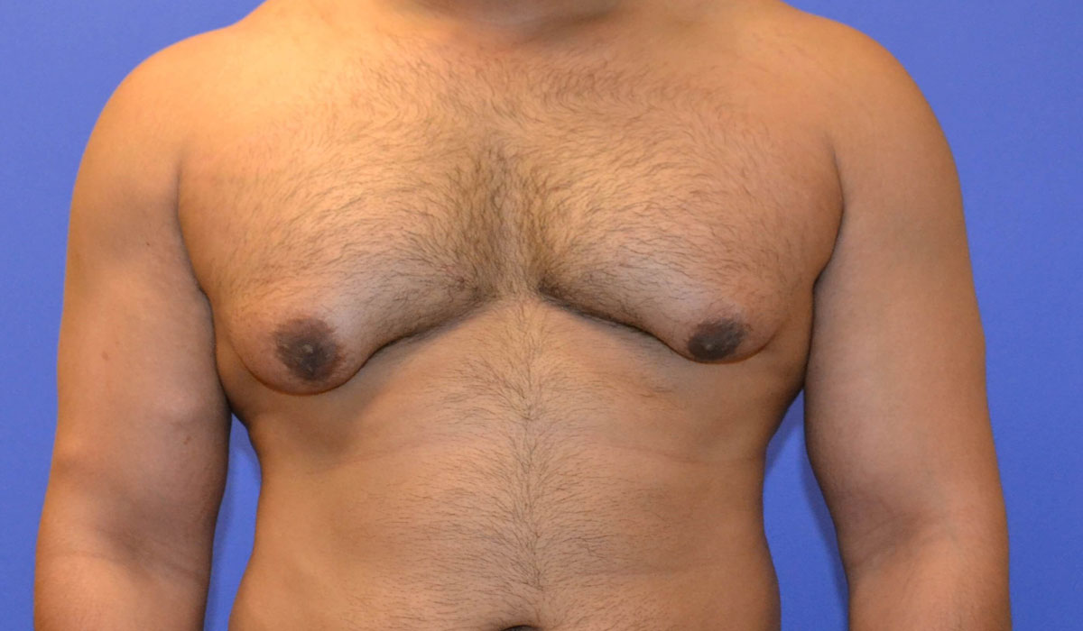 هل يمكن تشخيص وعلاج تضخم الثدي عند الرجال