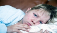 أسباب وأعراض الحصبة ومضاعفاتها عند الأطفال
