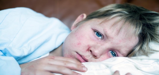 أسباب وأعراض الحصبة ومضاعفاتها عند الأطفال