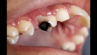 تعرف على أسباب وأعراض الإصابة بتسوس الأسنان