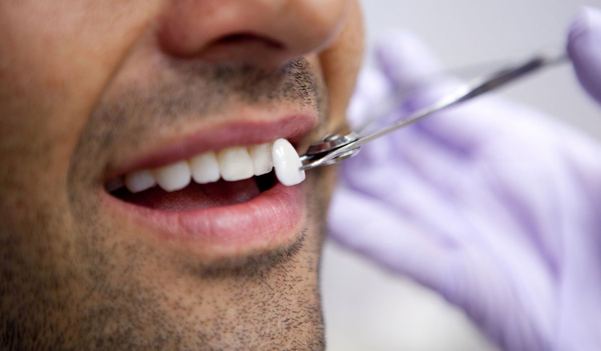 تعرف على أهمية تركيب اللومينير للأسنان وما هي مميزاته