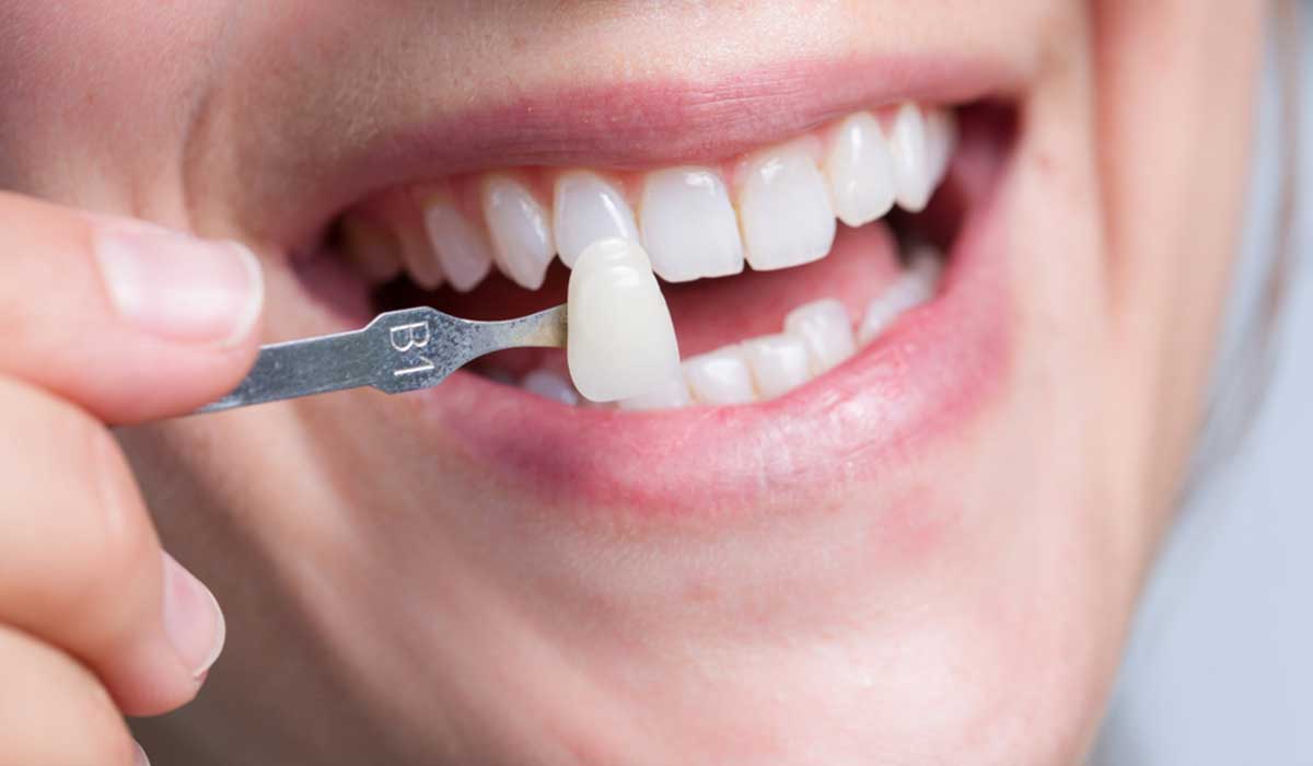 تعرف على أهمية ومميزات تركيب الفينير للأسنان