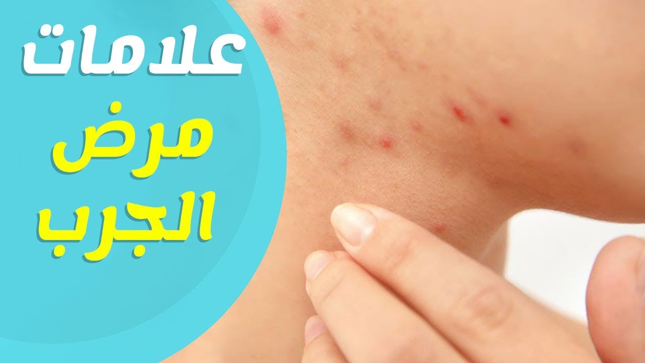 تعرف على الجرب أعراضه أسبابه وطرق الوقاية منه