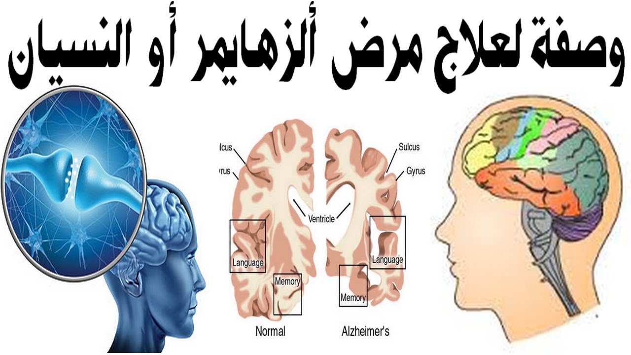 تعرف على مرض الزهايمر أعراضه والتغيرات التي تطرأ على المريض