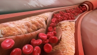 ماذا تعرف عن التصلب العصيدي وما تأثير الكولسترول الجيد على الدم