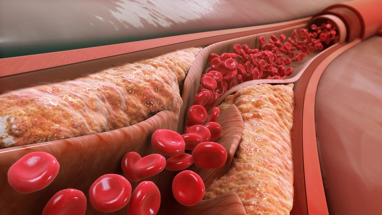 ماذا تعرف عن التصلب العصيدي وما تأثير الكولسترول الجيد على الدم