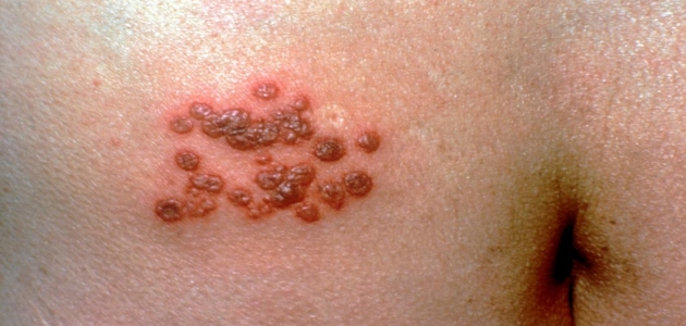 أخطر الأمراض الجلدية هو الحزام الناري كيف يمكن أن تكتشف الإصابة