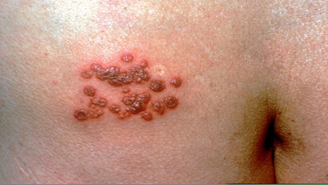 أخطر الأمراض الجلدية هو الحزام الناري كيف يمكن أن تكتشف الإصابة