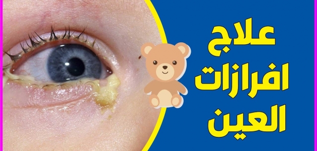 أسباب انسداد القناة الدمعية وتكون إفرازات العين عند الأطفال