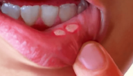 تقرحات الفم مشكلة صحية ناتجه عن فيروس الهريس