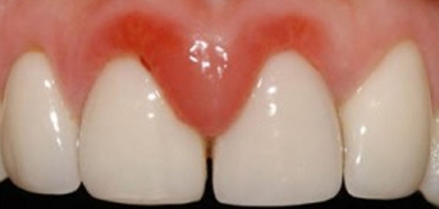 طريقة لتخفيف ألم خراج الأسنان وعلاجه بشكل صحي