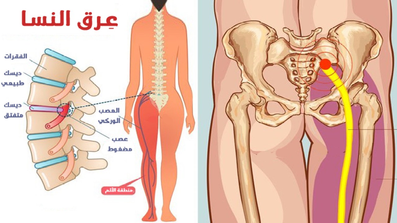 كيفية علاج عرق النسا بالطرق الطبيعية