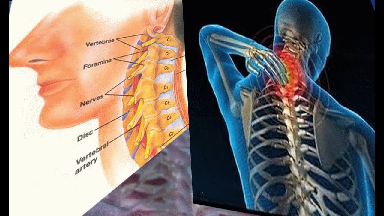 أسباب الانزلاق الغضروفي في الرقبة