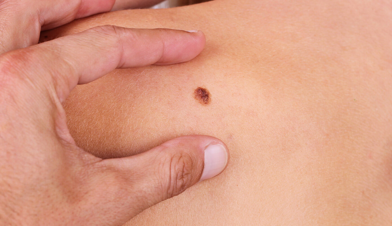 سرطان الجلد تعرف على أحدث سبل العلاج المناعي وطرق مقاومته