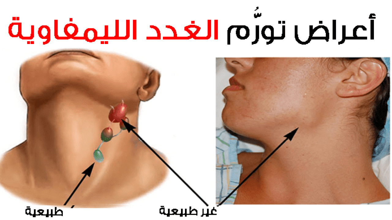 اللمفاوية الغدد علاج الغدد