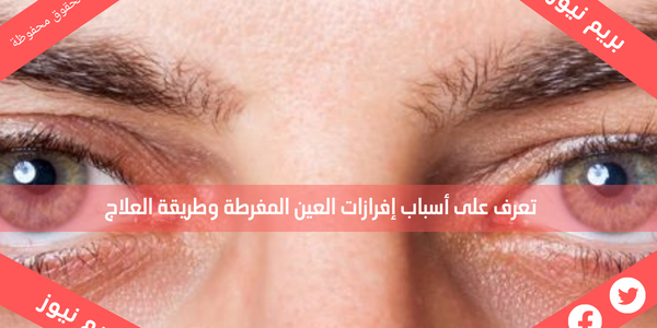 تعرف على أسباب إفرازات العين المفرطة وطريقة العلاج